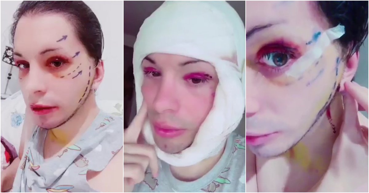 27YearOld Spends 80,000 On Plastic Surgery To Look Like 'Space Elf'