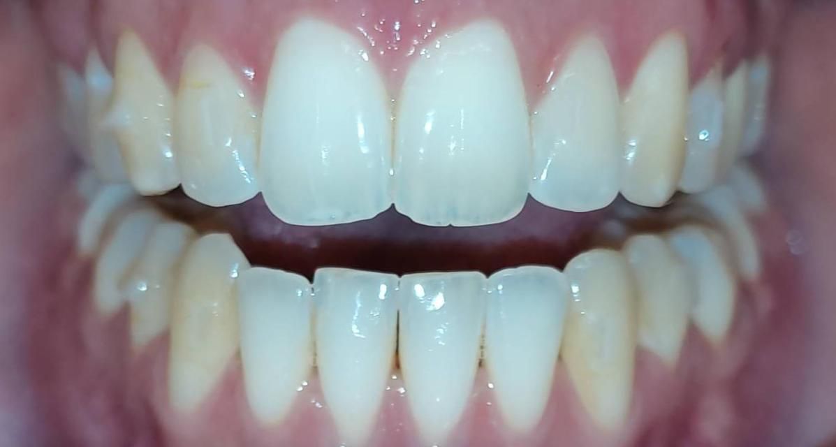 What is an open bite? Types, causes and how to fix it 🦷