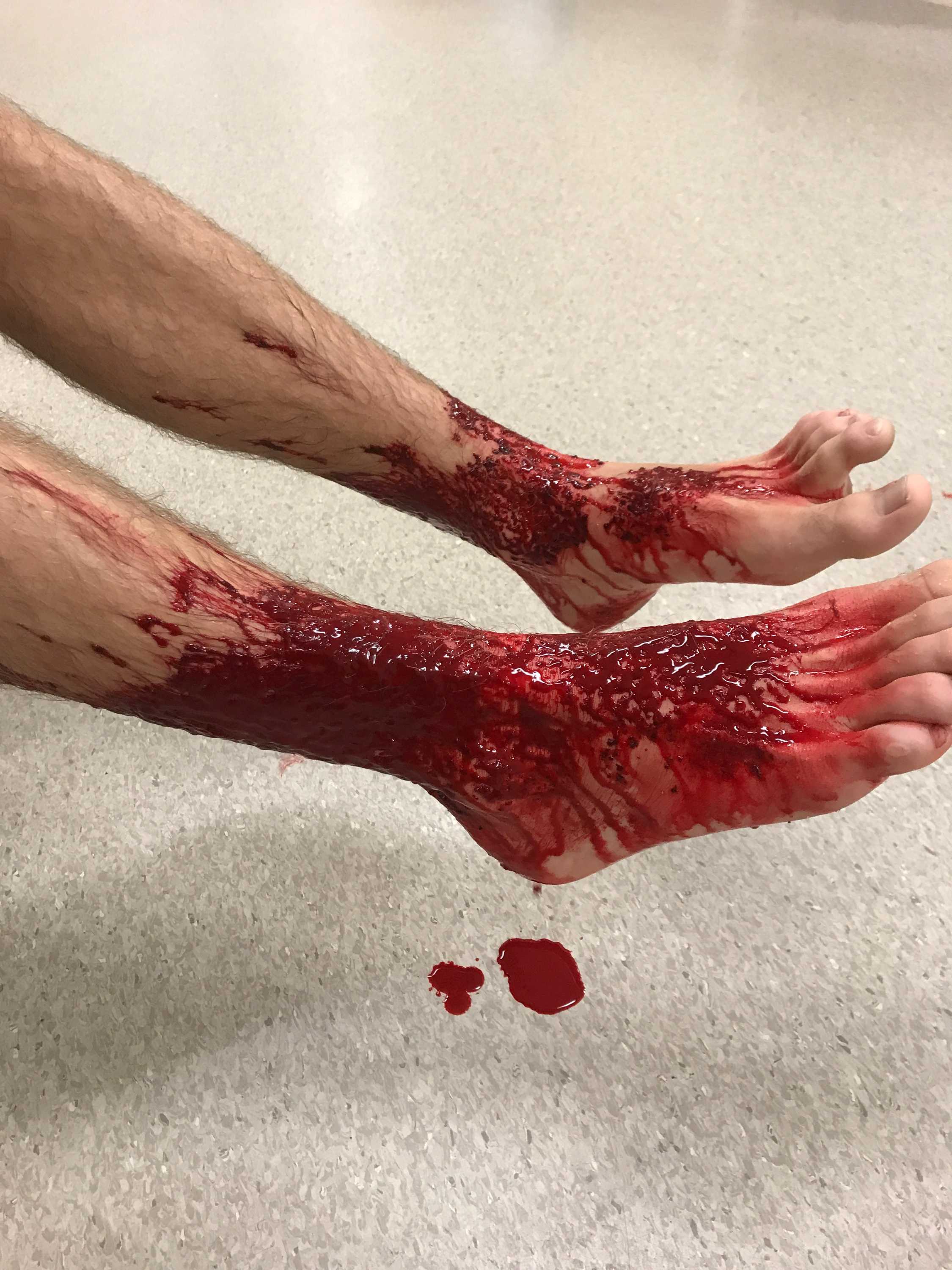 'Sea bug' creatures behind bloody attack on Melbourne teen's legs