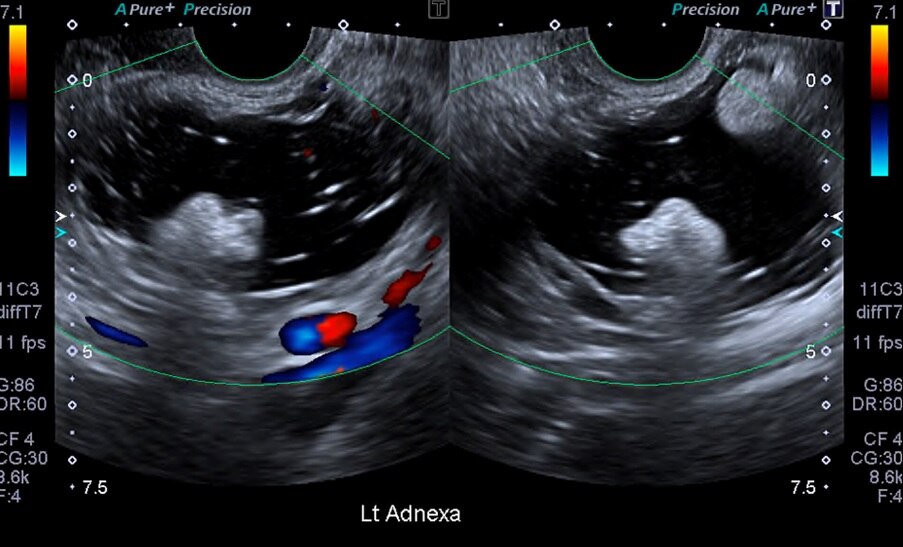 What's the deal with ovarian cysts? Breaking down the good, the bad and