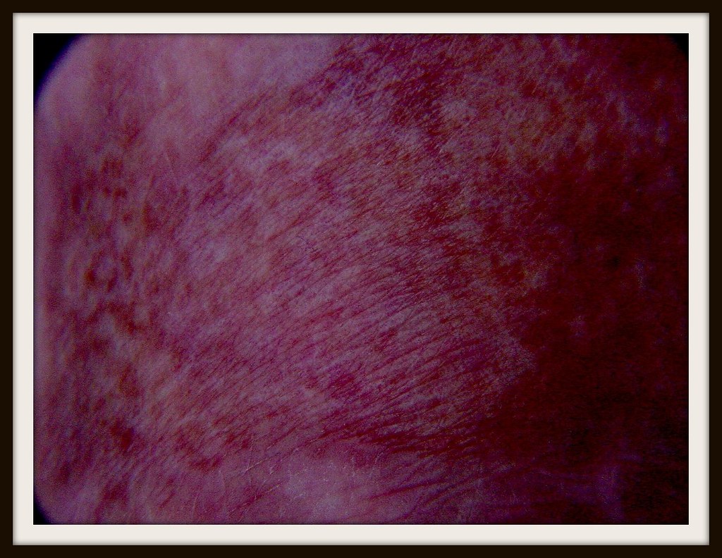 skin graft on foot mesh graft on foot weaponeer Flickr