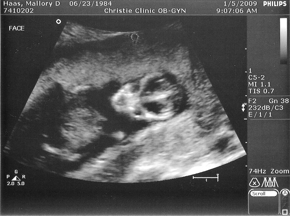 13WEEK ULTRASOUND Our first baby is seen in an ultrasound… Flickr