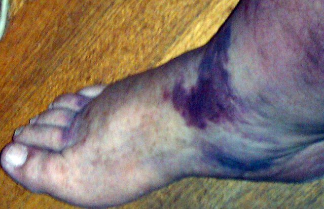 Bruised leg & foot I actually injured my leg, above and be… Flickr
