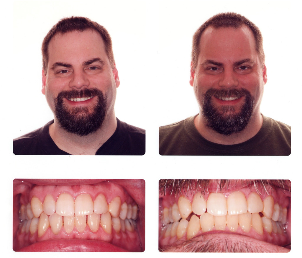 Braces Before and After (Bottom Teeth) Photo by Dr. John S… Flickr