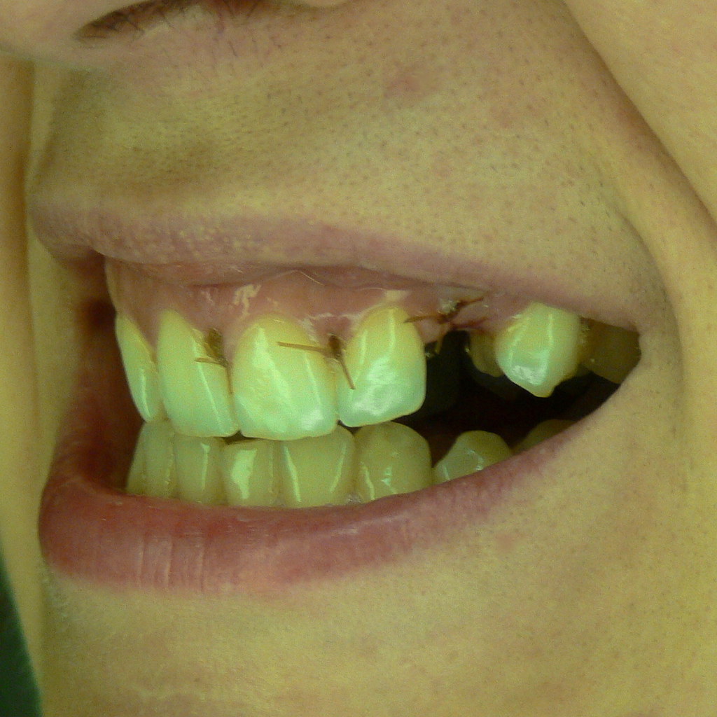 Oral Sutures I had oral surgery (again) and this time the … Flickr