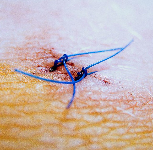 Stitch in knee recovery from my knee op. thought this woul… Flickr