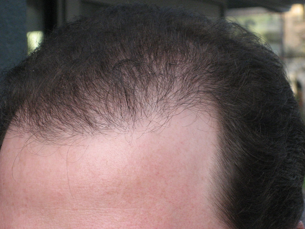 202 Days After Bosley Hair Restoration Procedure Follow my… Flickr