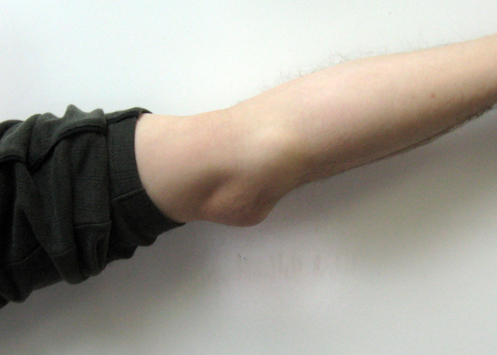 Elbow Bursitis I've been battling elbow bursitis (olecrano… Flickr