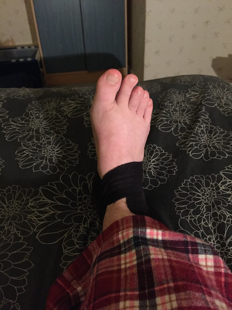 Black tape on sprained ankle Hazel Nicholson Flickr