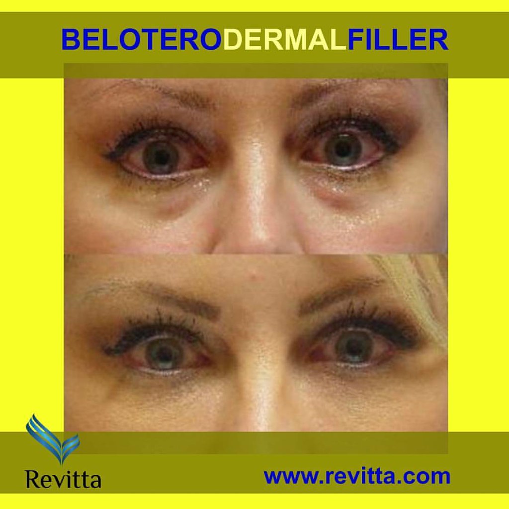 Belotero best filler for "tear troughs" and under eye ho… Flickr