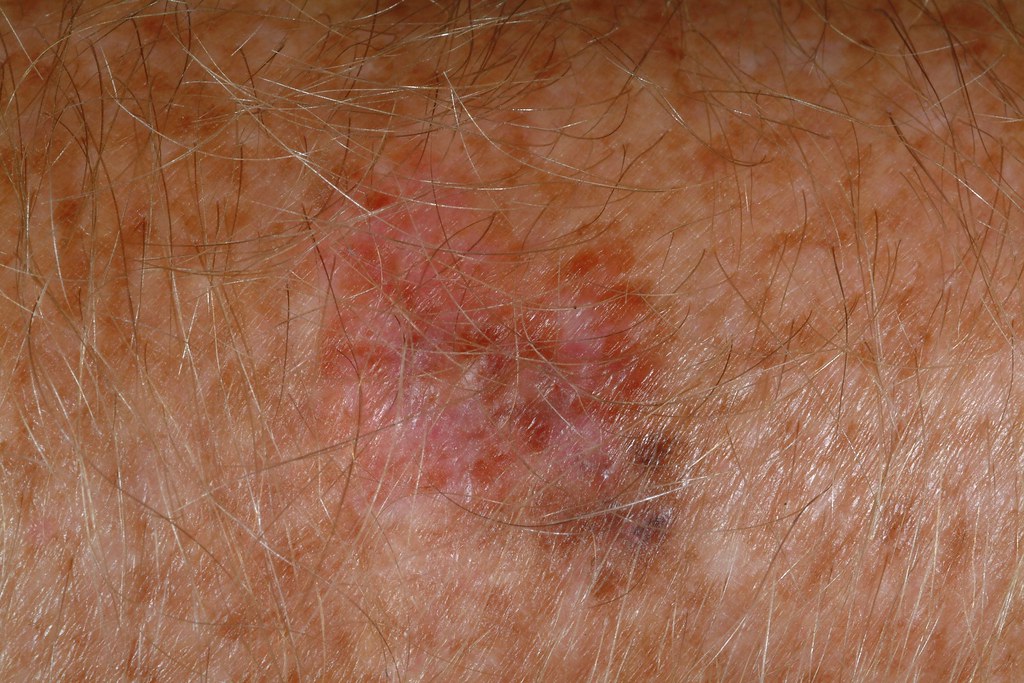 Malignant Melanoma This brown and pink lesion is located o… Flickr