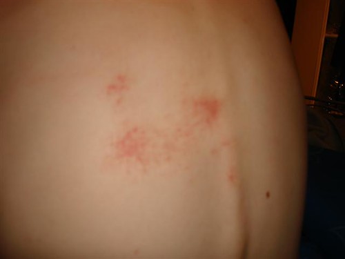 My back . . the OTHER carpet burn injury P I was rudely … Flickr
