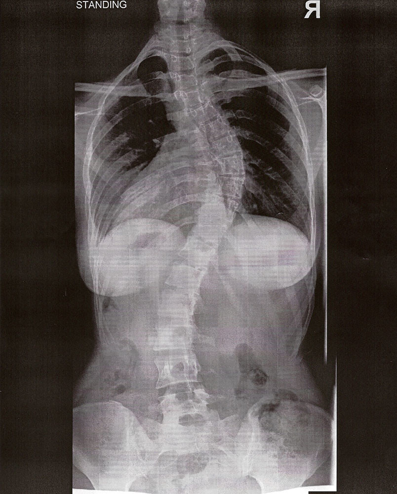 Scoliosis xray pre surgery front a photo on Flickriver