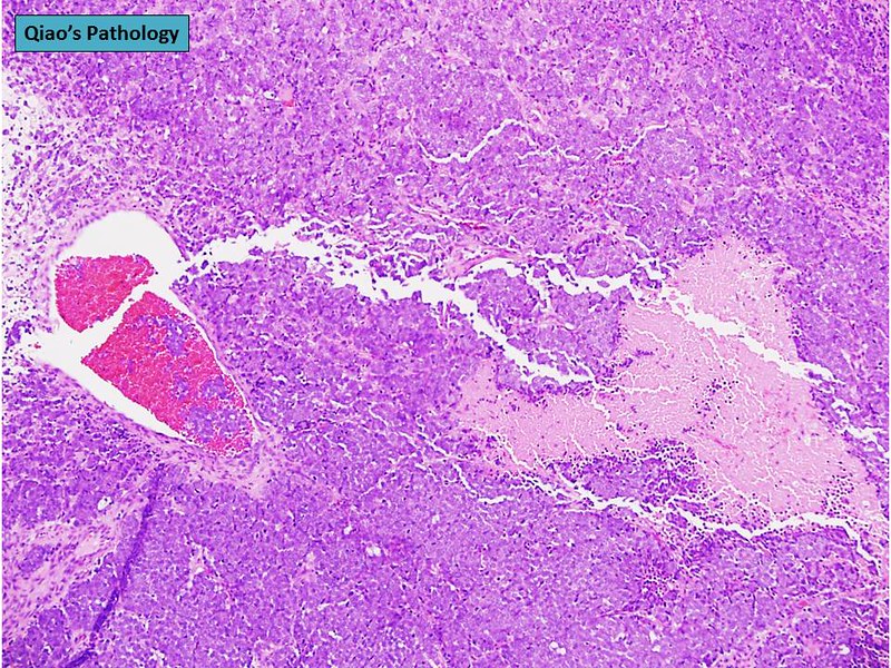 Merkel cell carcinoma Flickr