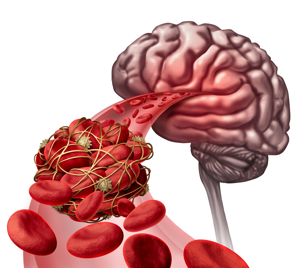 Brain Blood Clot NY