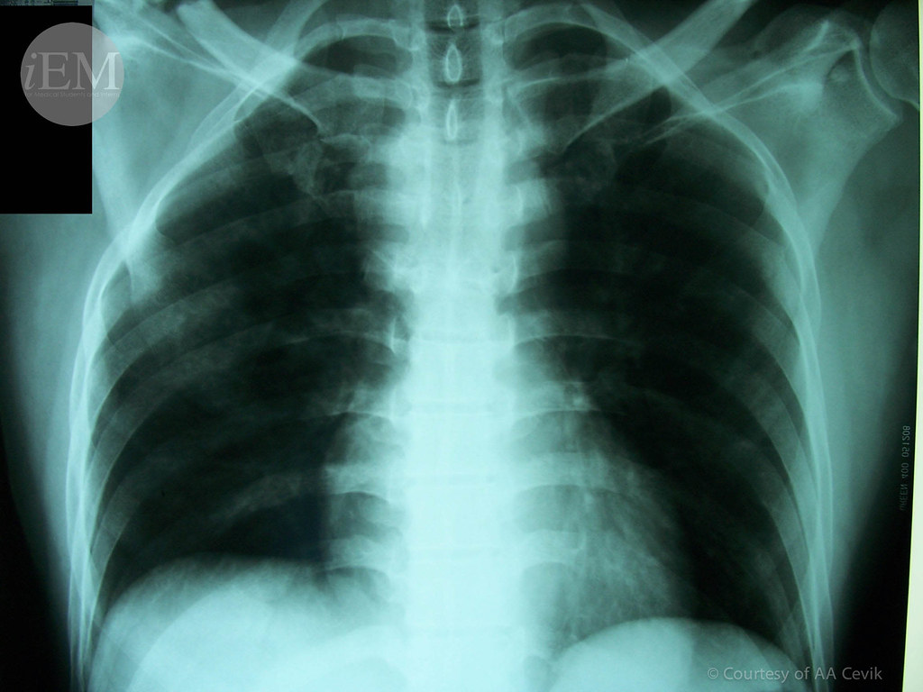 7 Flail chest case 4 Emergency Medicine Clinical Images and Videos