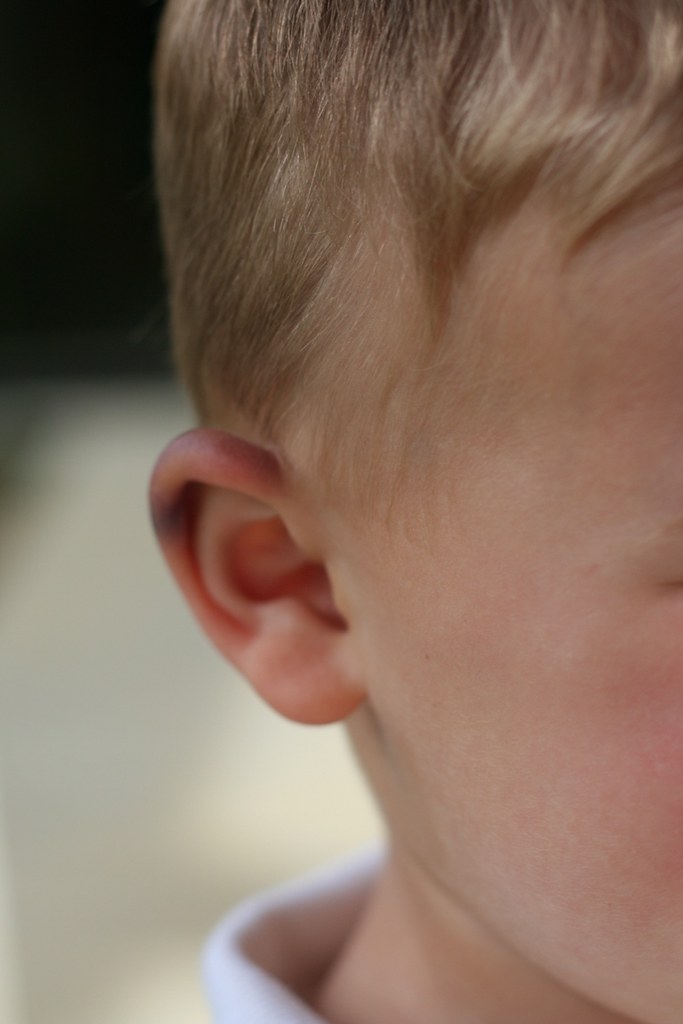 Colin's Bruised Ear GJ Charlet III Flickr