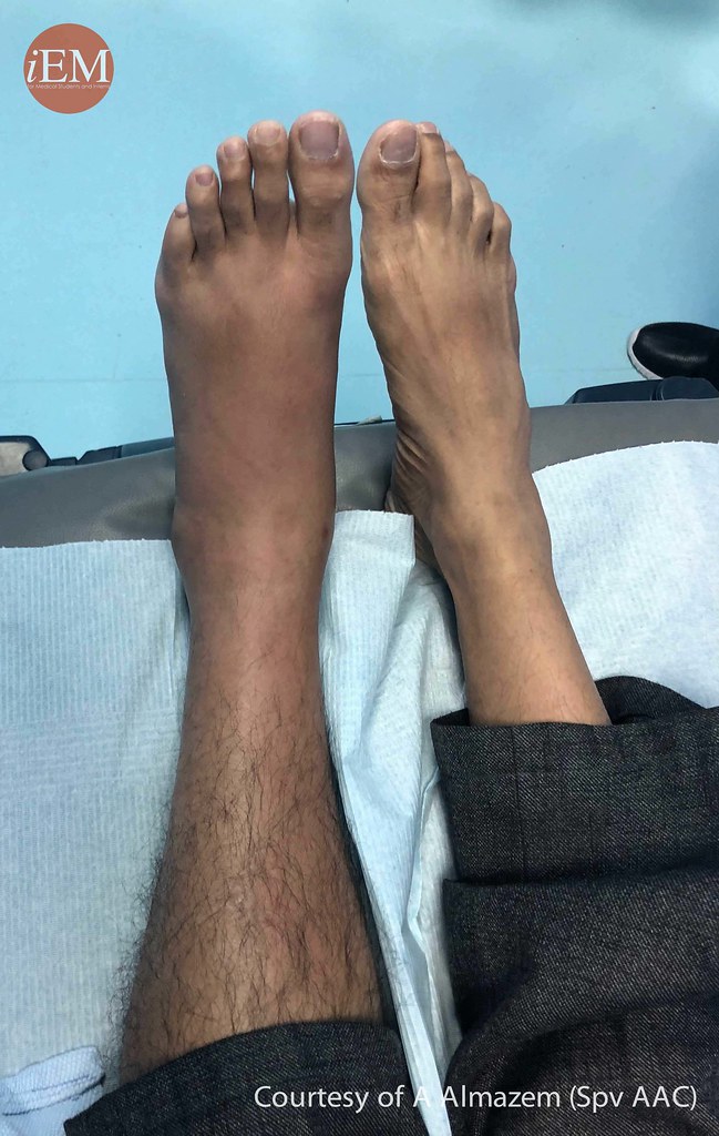 715.1 legfoot swelling 1 a photo on Flickriver