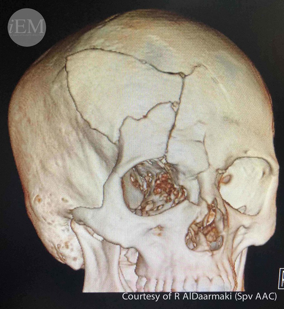 735.1i head trauma skull fracture A 31yearold male p… Flickr