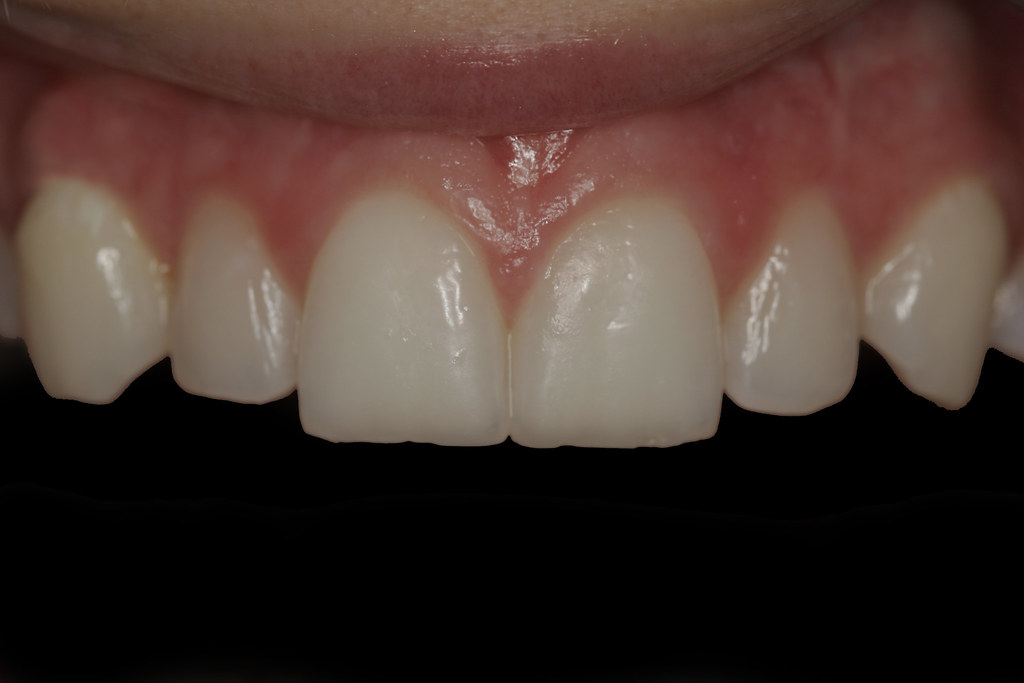 Close up picture of teeth Close up picture of teeth before… Flickr