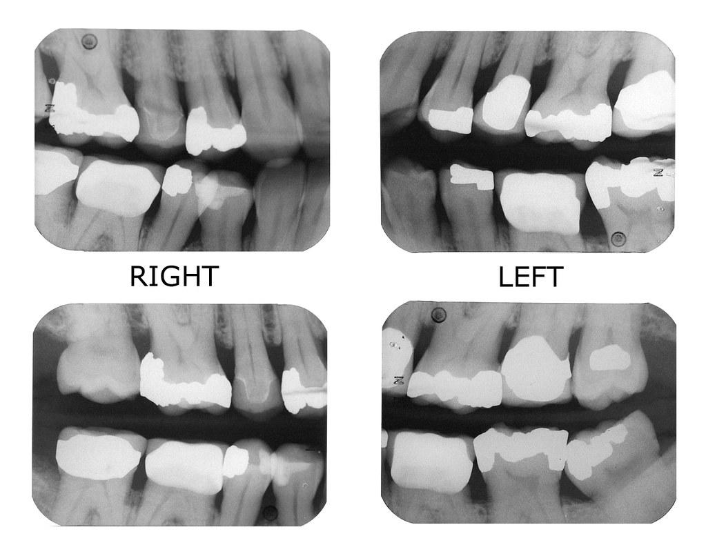 Bite Wings Typical set of four bite wing xrays. Sam Feinstein Flickr