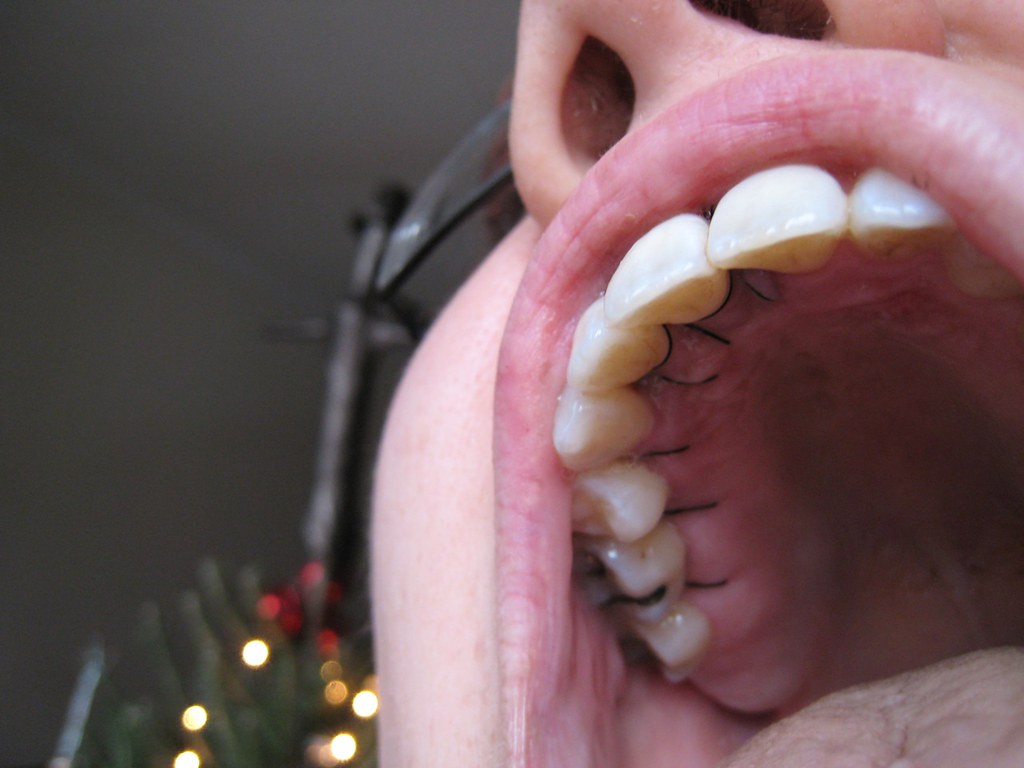 Flap Surgery 1 they sliced my gums open, around each toot… Flickr