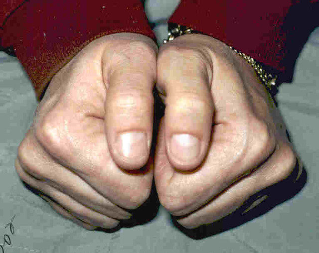 Various Vehicles Thumbs bent outward Enlarged bent knuckle… Flickr