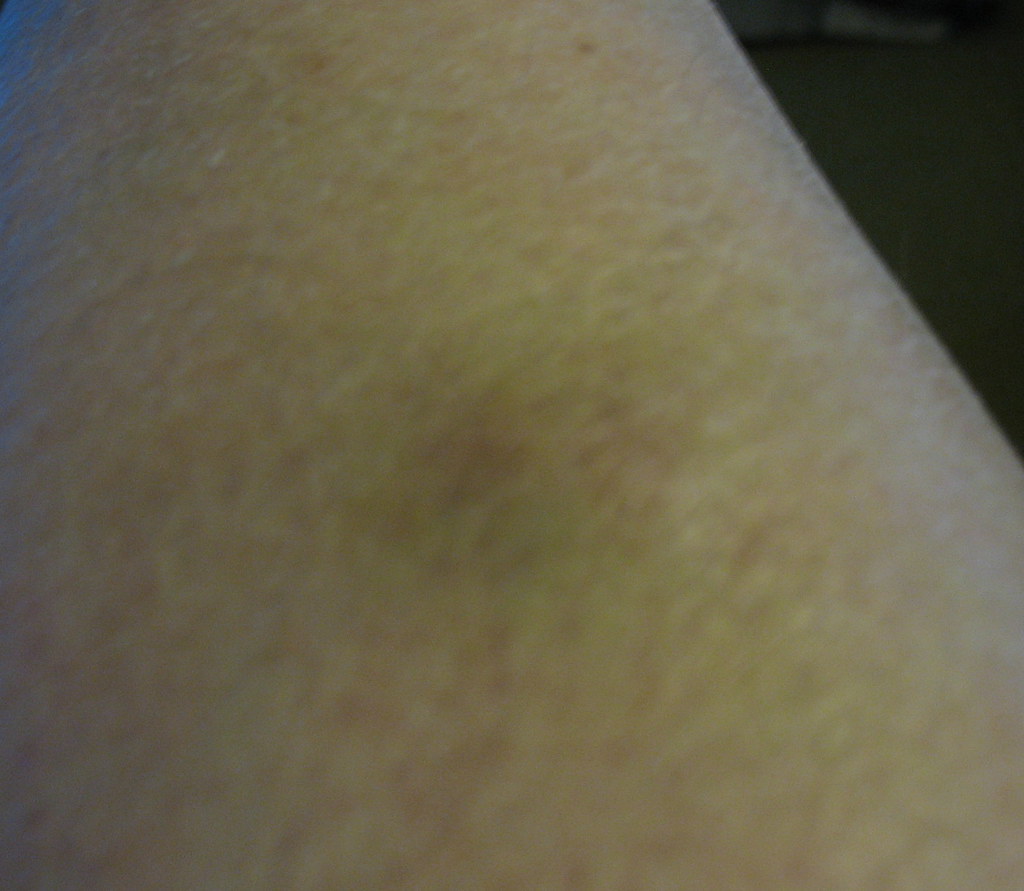 Bruise Still black and blue and lumpy after two weeks. Day… Flickr