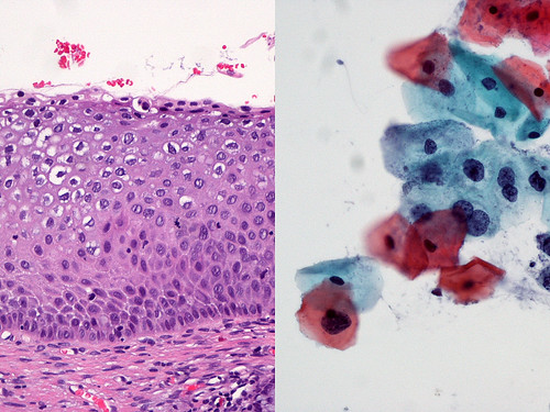 Cervix Mild dysplasia Left Mild squamous dysplasia (CIN1… Flickr