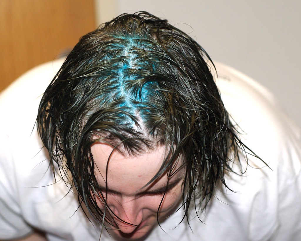 Blue Scalp I dyed my hair Blue for halloween. Cory W Flickr