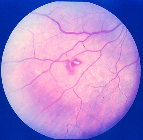 Hemorragias. Mancha de Roth. MicroangiopatÍA retiniana Flickr