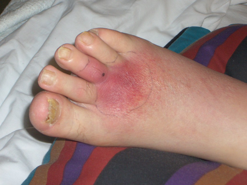 MRSA MRSA Infection Flickr