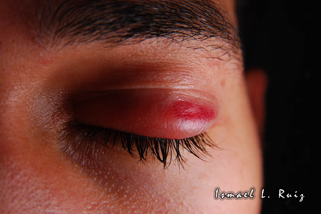 Eye Surgery (eye closed) I had an eye surgery done to my l… Flickr