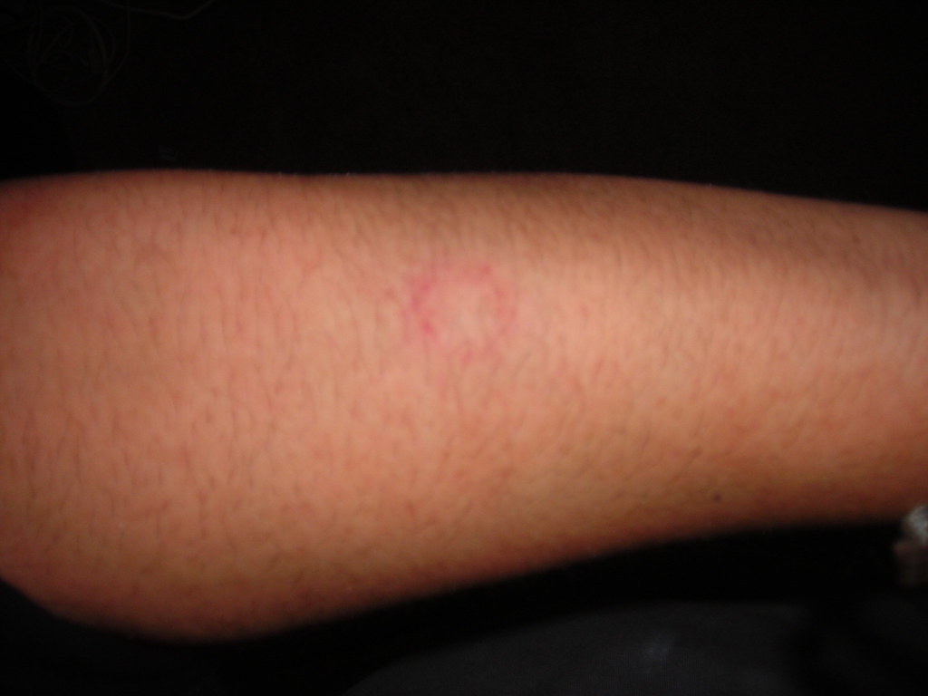 March Paintball This is one of the welts on my lower arm t… Flickr
