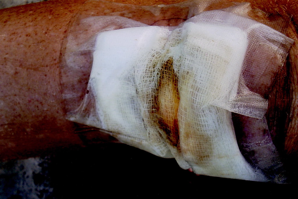 Staph Infection! Bandage ⊙ ☂︎♙₪୬〰⋀ℵ⊃ ⊙ Flickr