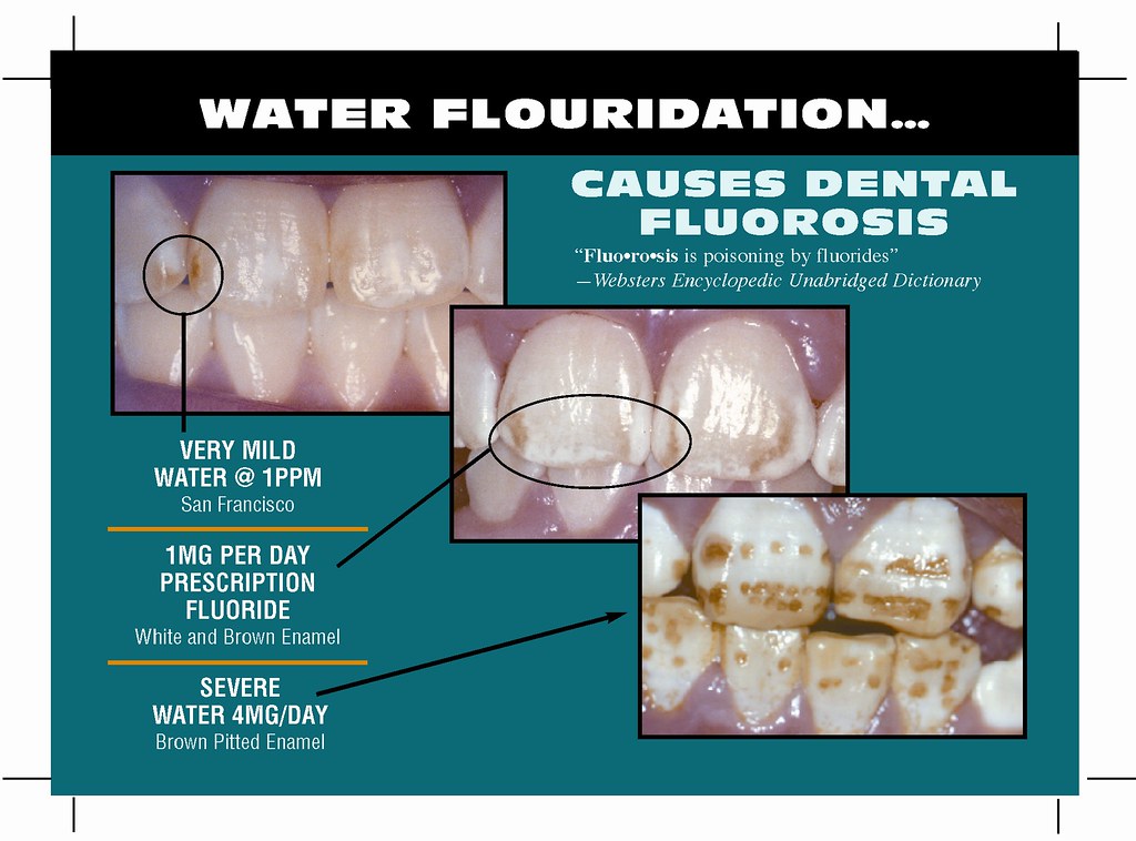 Three Stages of Dental Fluorosis Great pictures showing th… Flickr