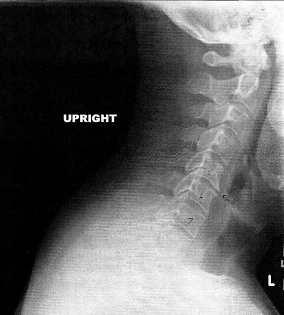neck xray I've got a herniated disc and some arthritis in … Flickr