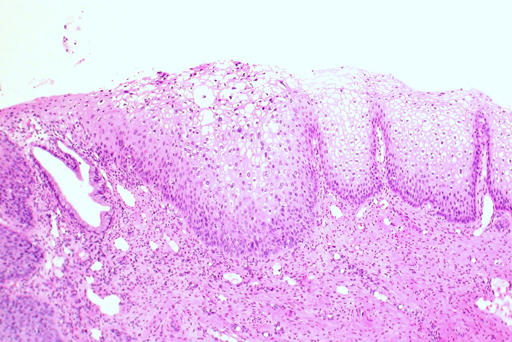 Exocervix Lowgrade squamous intraepithelial lesion Flickr