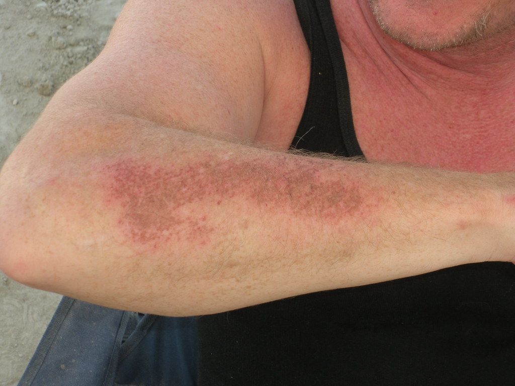 Rug burn Coming down the slide on a forearm. Phil Stripling Flickr