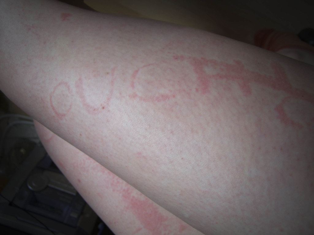 26 Images of Hives (Urticaria) on Skin