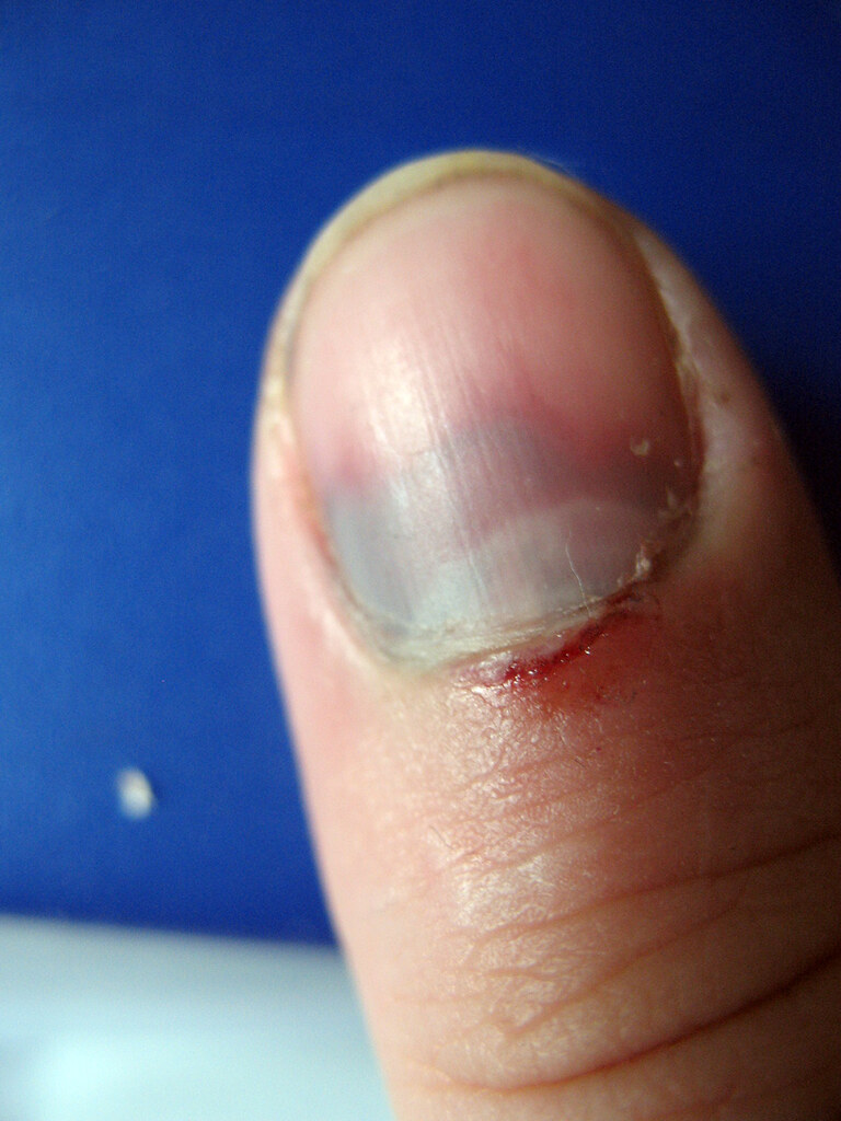How to Fix a Subungal Hematoma Part 1 of 4 So, your thum… Flickr