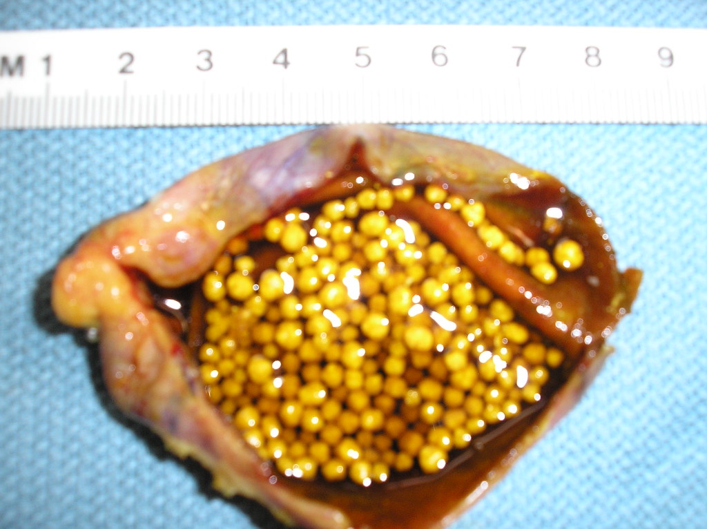 Qiao's Pathology Cholesterol gallstones Gallbladder Gros… Flickr