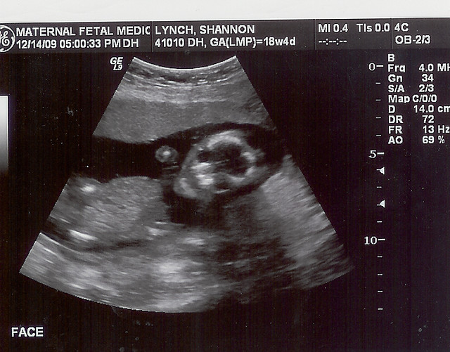Ultrasound 18 to 19 weeks. face. Facing forward Jim Lynch Flickr