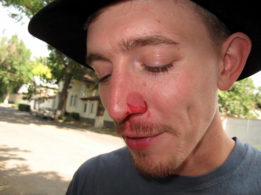 Dry Air, Bloody Nose or maybe he's just a wimp? Peretz Partensky