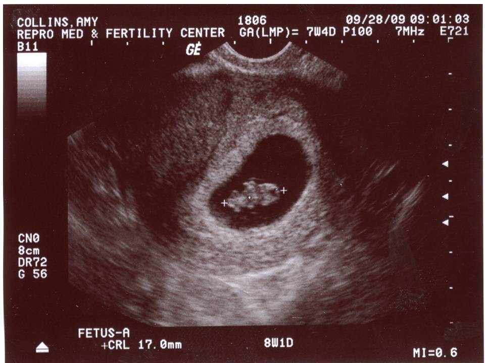 7_weeks_4_days_ultrasound__BABY_A Nancy Flickr