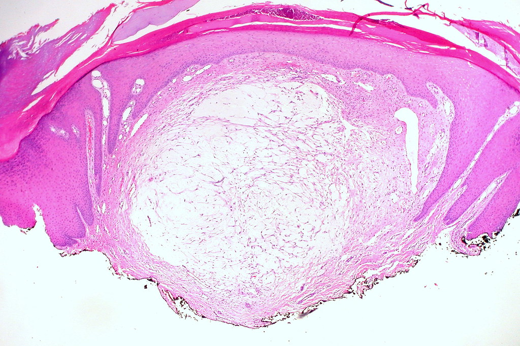 Digital Mucous Cyst, Foot Ed Uthman Flickr