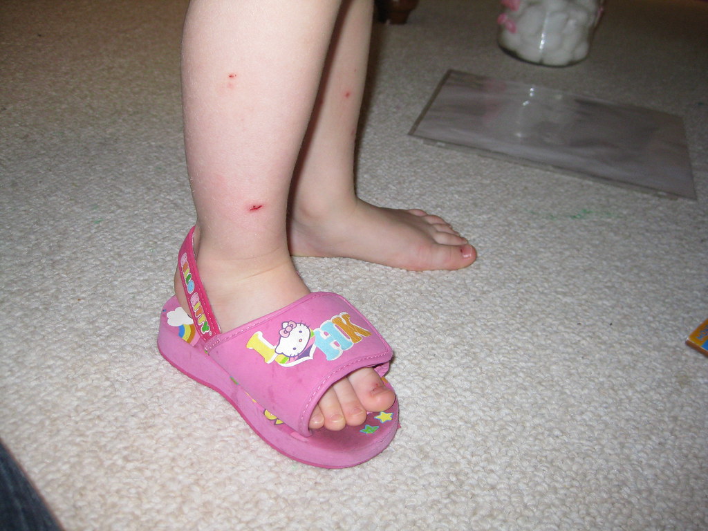 mosquito bites/missing shoe/wrong foot shoe Emily Halbardier Flickr