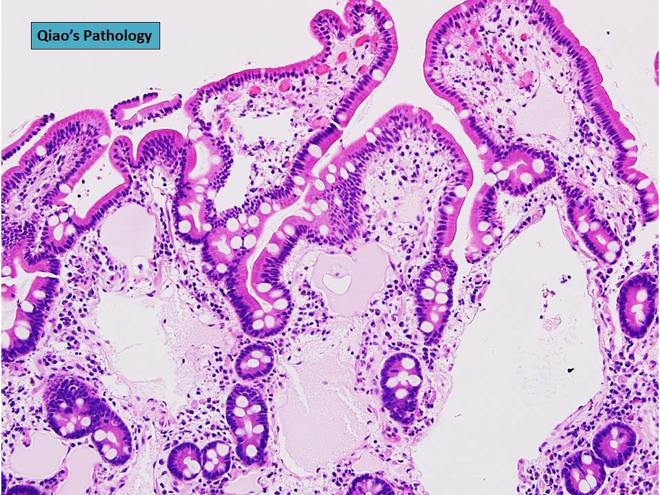 Qiao's Pathology Primary Intestinal Lymphangiectasia Flickr