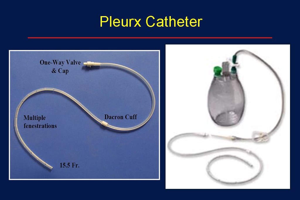 Carefusion Denver Pleurx Peritoneal Catheter Placement