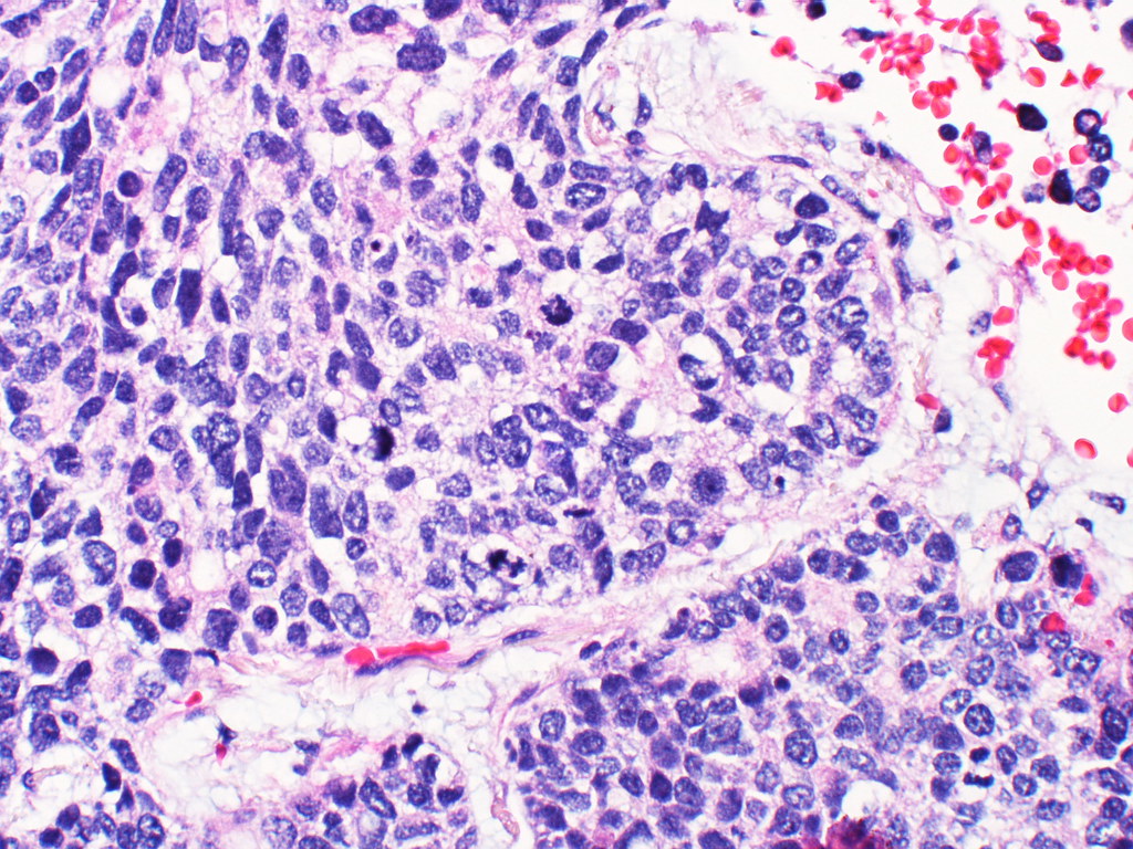 Large cell neuroendocrine carcinoma Case 120 Yale Rosen Flickr